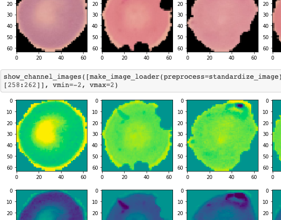 Malaria cell classification screenshot